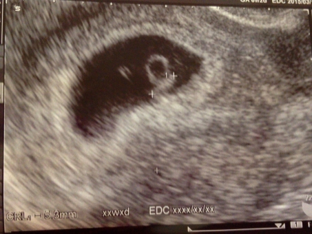 妊娠初期の胎児の成長